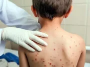 Entra Quintana Roo a fin de semana largo con 83 casos de Sarampión